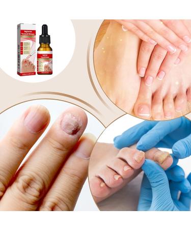 Nail and Toenail Strengthening Liquid | 10ml Ingrown Toenail Corrector Drops Beauty Care for Hands and Feet Nighttime Travel Treatment for Dry Damaged Cracked Curved Fragile and Chipped Nails - Buy Online on GoSupps.com