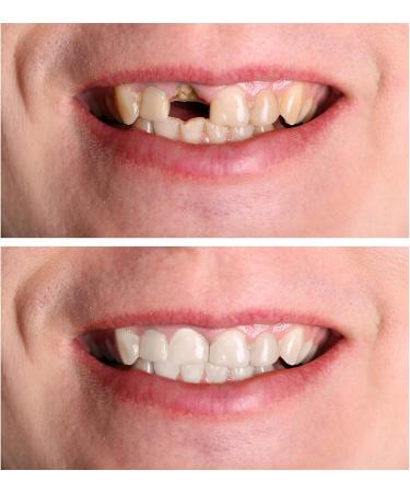Jiazhou Hub 2 Pairs Prostheses - High-Quality Fake Teeth & Immediate Veneers for a Stunning Smile - Buy Online on GoSupps.com