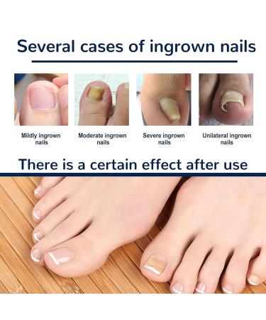 100 PCS Breathable Self-Adhesive Toenail Correction Patch - Ingrown Toenail Corrector Stickers Blue - Buy Online on GoSupps.com