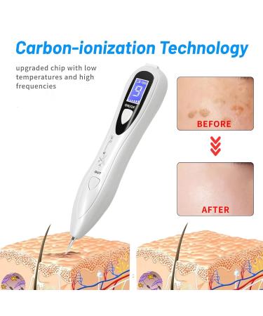 CHRERNA Plasma Pen Device for Hand & Body - Remove Warts Moles Pigment Spots Age Spots | Fast International Shipping - Buy Online on GoSupps.com