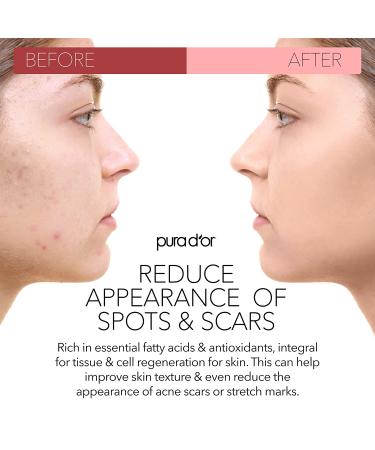 PURA DOR Organic Scar & Stretch Mark Treatment Oil | 1oz For Skin - Rosehip, Wheat Germ, Argan, Tamanu, Carrot, Rosemary, Lavender, Geranium, Patchouli, Sage - Buy Online on GoSupps.com