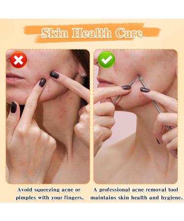 JIEYAO 4-Piece Tweezers Set for Removing Blackheads Pimple Ejector Tool Set Blackhead Extractor Tweezers for Whiteheads Blemishes Comedones Make-Up Tool Made of Stainless Steel - Buy Online on GoSupps.com