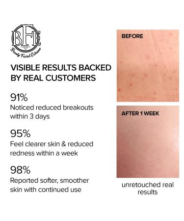 Anti-Acne Buttocks & Thigh Treatment - Clear Acne, Pimples & Ingrown Hairs | 6.9 OZ - Buy Online on GoSupps.com