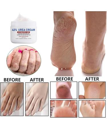 Cracked Heel Repair Cream - 42% Urea Foot Cream - Foot Cream for Cracked Heels and Dry Skin - Foot Cream for Callus Remover & Nourishes Soften - Urea Cream - Skin Care Hands & Feet - Buy Online on GoSupps.com