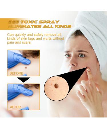 Tag Recede Bienengift Treatment Spray 20ml - Effective Beeergift Solution (1 Piece) - Fast International Shipping - Buy Online on GoSupps.com