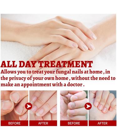 Quick Relief Oil Fungal Nail Treatment Rapid Relief Oil Nail Fungus Treatment For Toenail Nail Treatment Oil Toe Nail Fungal Treatment Onychomycosis Nail Treatment Toenail Repair for Damaged Nails - Buy Online on GoSupps.com