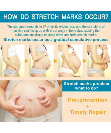 PEGO Pregnancy Stretch Mark Prevention Belly Cream with Shea Butter Body Oil Prevent & Reduce Stretch Marks During Pregnancy and Postpartum Massage Lotion Pregnancy Skin Care (300ml/1pack) - Buy Online on GoSupps.com