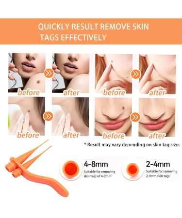 MEIJU Skin Tag Removers | 2-in-1 Removal Kit for Small to Large Skin Tags | Easy Application Device with 36 Repair Patches - Yellow - Buy Online on GoSupps.com