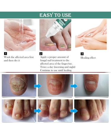 Extra Strong Fungal Nail Treatment for Toenails - Nail Repair Oil for Ingrown Nails - Strengthen and Renew Damaged Nails - 3Pcs Set - Buy Online on GoSupps.com