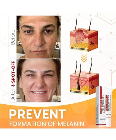 Spot Off Freckle Whitening & Dark Spot Corrector Cream - Acne Scar & Melasma Removal Treatment for Face (2 Pcs) - Buy Online on GoSupps.com