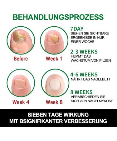 MrCuvaryas Ginger Nail Care Oil Nail care oil Nail care serum for brittle discolored and broken nails ginger cuticle care oil for nails nail care oil nail hard nail care for - Buy Online on GoSupps.com