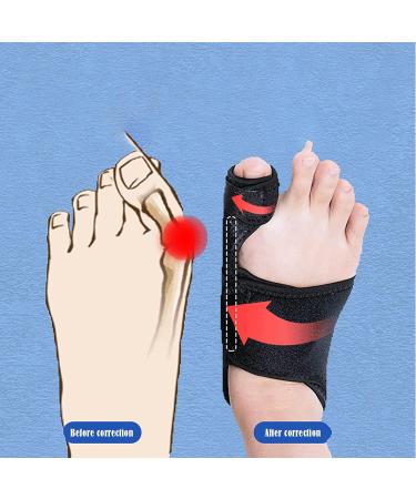 ALINZO Bunion Corrector Sleeves - Non-Surgical Bunion Relief & Toe Separator for Pain Relief - Buy Online on GoSupps.com