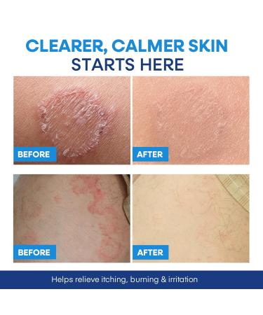 Hermon Antifungal Body Wash for Jock Itch: Tea Tree oil Body Wash for Jock Itch Ringworm Back Acne Athlete's Foot Tinea - Medicated Soap for Men and Women 1 Pack Body Wash - Buy Online on GoSupps.com