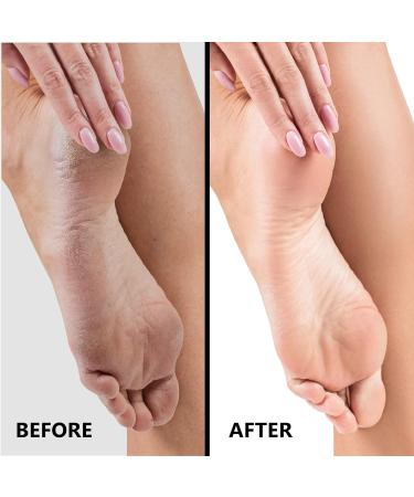 SlkySmooth 3-in-1 Foot File - Callus Remover, Corn Removal, Exfoliating Heel Scrubber - Buy Online on GoSupps.com
