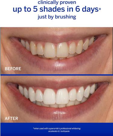 Buy Supersmile ICY Mint Whitening Kit with Rinse | Best International Shipping & Teeth Whitening Solution - Buy Online on GoSupps.com