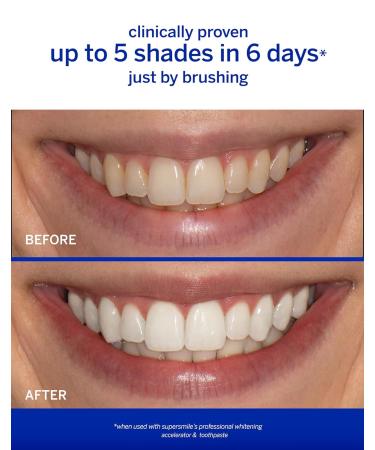 Supersmile Original Mint Whitening Kit - Enhance Your Smile | International Shipping Available - Buy Online on GoSupps.com