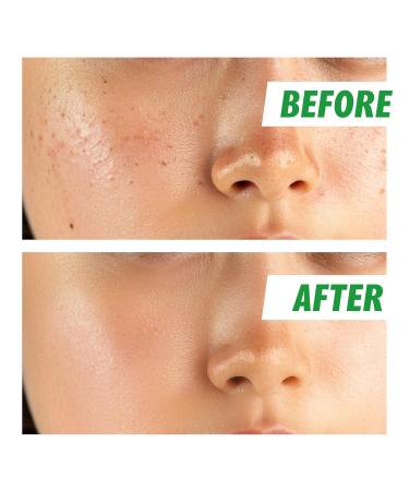 Nightingale TEATAMIN Facial Treatment Essence - Redness Relief Korean Toner for Sensitive Skin Hypoallergenic & Cruelty-Free Skincare with Tea Tree & Vitamins - Buy Online on GoSupps.com