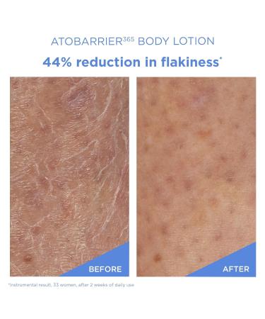 AESTURA ATOBARRIER365 Korean Body Lotion with Ceramides | Fast-Absorbing Moisturizer for Dry Sensitive & Eczema-Prone Skin | Non-Comedogenic Fragrance-Free 400 mL / 13.5 fl oz - Buy Online on GoSupps.com