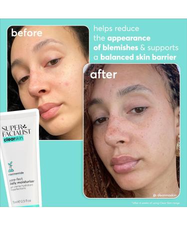 Super Facialist Breakout Buster Serum - Clear Skin Solutions Spot Treatment for Acne with 10% Niacinamide Tea Tree Oil & Prebiotics Vegan Friendly 30ml - Buy Online on GoSupps.com