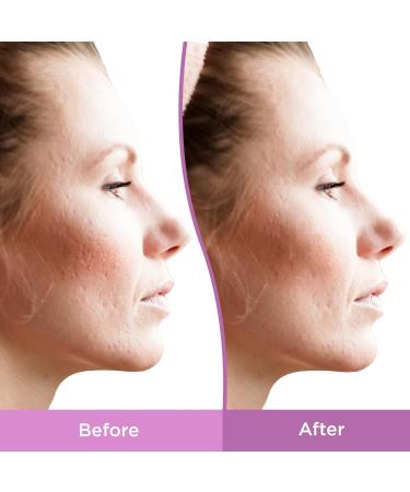 Buy Differin Resurfacing Scar Gel 1 fl oz â€“ Effective Acne Scar Treatment - Buy Online on GoSupps.com