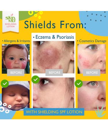 Skin MD Shielding Lotion 4oz + SPF 15 - Eczema & Psoriasis Relief for Face Body & Hands | Best Dry Skin Remedy - Buy Online on GoSupps.com