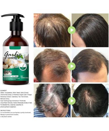 ANCHORAGE Garlic Shampoo 100ml AntiHair Loss Shampoo with Organic Oil Men Plant Extract Itch Relief Dandruff Removal Hair Loss Treatment - Buy Online on GoSupps.com