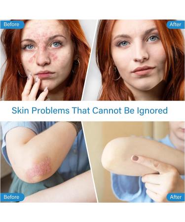 MEOLY Psoriasis Eczema Rosacea Cream 60 ML - Anti-Itch & Dry Skin Relief Treatment - Buy Online on GoSupps.com