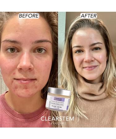 CLEARstem HYDRAGLOW Anti-Aging Stem Cell Moisturizer with Bakuchiol 1.7 Oz - Skin Hydration & Youthful Glow - Buy Online on GoSupps.com