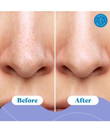 Buy Blackhead Remover & Pore Minimizer Kit - 10 Nose Strips Exfoliating Swabs 1oz Toner - Natural Ingredients for Clear Skin - Buy Online on GoSupps.com