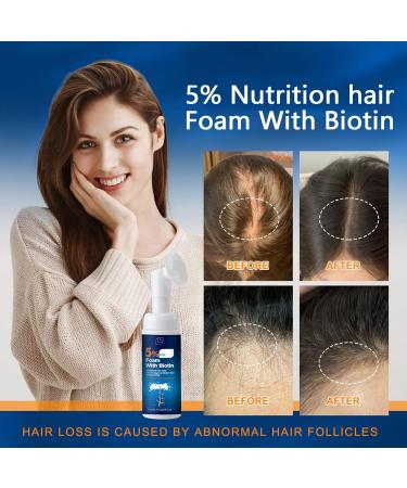  Generisch 5% Minoxidil Foam for Men and Women Minoxidil 5% Hair Growth Serum for Hair Growth Hair Loss Treatment Beard Growth for Lo - Buy Online on GoSupps.com