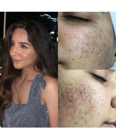 Pro Advanced Hyaluronic Acid Serum | Vitamin C & Niacinamide Face Lift | Hydrating Anti-Aging Serum for Dry Skin - 2oz - Buy Online on GoSupps.com