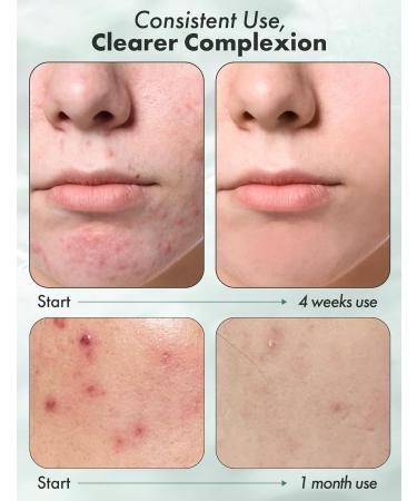 Tea Tree Moist Soothing Foaming Facial Cleanser | Korean Beauty Face Wash for Oily Skin | Hydrating Face Wash with Tea Tree Oil - 4.05 fl oz - Buy Online on GoSupps.com