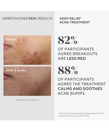 Murad Deep Relief Acne Treatment - Acne Control Max Strength 2% Salicylic Acid for Deep for Uncomfortable Cystic Acne 30 ml - Buy Online on GoSupps.com