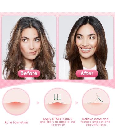 Acne Pimple Patch 226 Dots Star Pimple Patches Spot Stickers - Tea Tree Oil & Centella Oil - Effectively Calms & Relieves Acne - for Pimples Blemishes Zits Acne - Buy Online on GoSupps.com