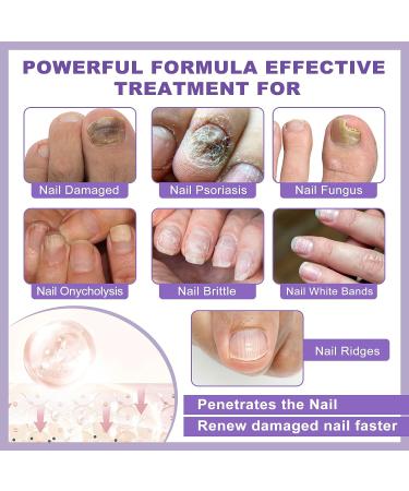 Extra Strength Toenail Fungus Treatment - Nail Repair for Damaged Nails - Fungal Nail Renewal 1oz - Buy Online on GoSupps.com