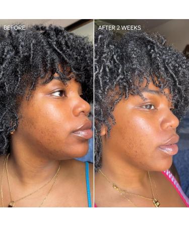 Dermisa Skin Fade Cream with Vitamin C | Helps Reduce Dark Spots and Age Spots | All Skin Types | 1.78 OZ | Pack of 1 1.78 Ounce (Pack of 1) - Buy Online on GoSupps.com