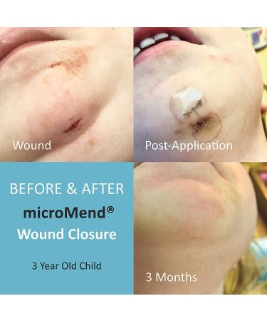 microMend Emergency Wound Closures Kit - Surgical Quality Laceration Repair Without Stitches - Includes 2 Medium Devices, Gauze, and Antiseptic Wipe - Buy Online on GoSupps.com