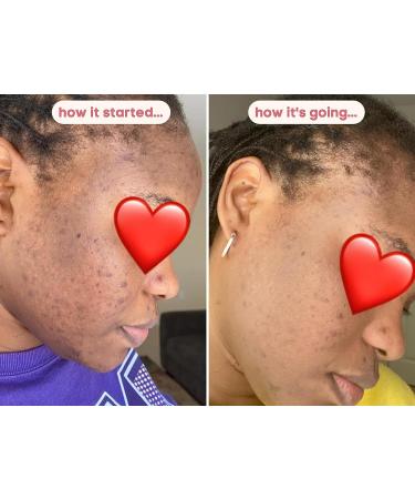 Maximum Strength Kojic Acid Skin Brightening Soap for Hyperpigmentation & Dark Spots - 5.3 oz - Buy Online on GoSupps.com