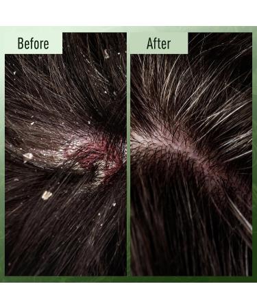 ABERA Folliculitis Body Wash for Men & Women High-Performance Shower Gel with BHA Wild Bitter Melon & Tea Tree 1 Box + Ginseng Anti Dandruff Shampoo Scalp Fungus Treatment Reduce Itching (Set 2) D. Set 2 - Buy Online on GoSupps.com