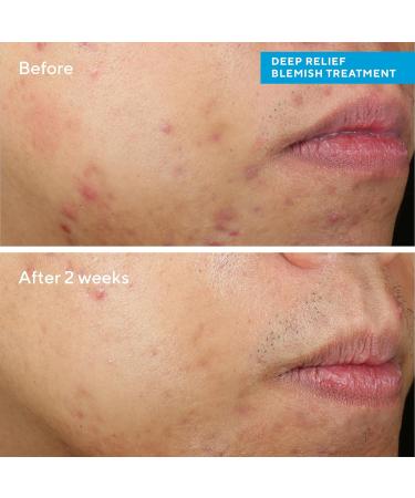 Murad Deep Relief Blemish Treatment - Blemish Control - Max Strength 2% Salicylic Acid Healing Treatment for Deep Uncomfortable Cystic Blemish - 30ml - Buy Online on GoSupps.com