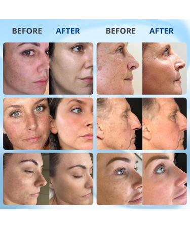 ABERA Retinol Serum Best Melasma Treatment For Face Niacinamide & Vitamin A Anti Aging Serum Remove Freckles Wrinkles & Dark Spots Brightening Serum for Glowing Skin (Set 3) - Buy Online on GoSupps.com