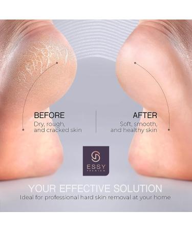 Essy Electric Foot Callus Remover Kit - Dead Skin Remover for Feet - Buy Online on GoSupps.com
