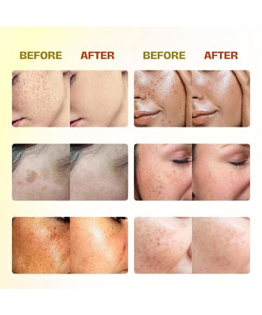 Abera Combo Melasma Treatment for Face Dark Spot Corrector Double Effect with Combo Serum and Cream Abera Melasma Serum with Abera Melasma Cream (3 Serum 1 Cream) - Buy Online on GoSupps.com