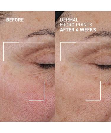 Dr. Brandt Needles No More Dermal Micro Points - Intensive Skin-Lifting Gel to Boost Collagen Even Skin Texture & Smooth Wrinkles & Fine Lines - 1.0 oz - Buy Online on GoSupps.com