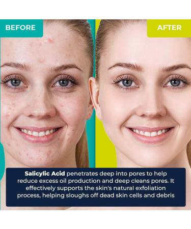 LivaClean (360 Count 10 Pack) Hydrocolloid Patches w/Salicylic Acid - Hydrocolloid Patch Face Hydrocolloid Patches Overnight Face Patches 10 Pack 360 Count S.acid Patches - Buy Online on GoSupps.com