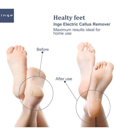 Inge Hard Skin Remover Foot Electric | Hard Skin Remover | Foot Files for Hard Skin | Foot Scrubber with USB Cable | 3 Interchangeable Heads White - Buy Online on GoSupps.com