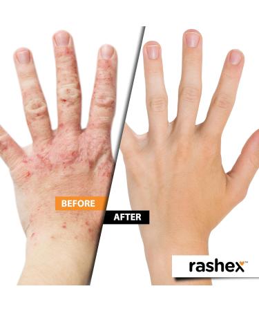 Rashex Eczema & Psoriasis Treatment Ointment | Black Ichthammol 20% | Fast Relief | 2 Oz Tube - Buy Online on GoSupps.com