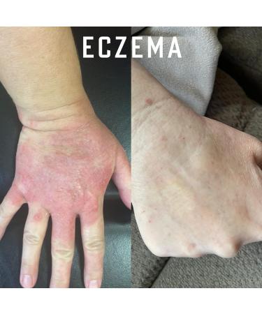 Buy Pure Organic Ozonated Olive Oil Extra Strength 1200 - Acne Anti-Aging Rosacea Treatment for Sensitive Skin - Made in Spain - Buy Online on GoSupps.com