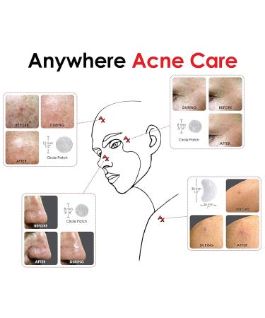 AX Acne Hydrocolloid Pimple Patch Bandage Variety Pack | Skincare Spot Treatment for Clearing Pores and Blemishes - Buy Online on GoSupps.com