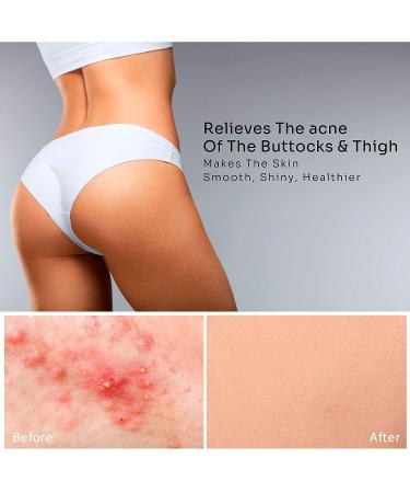 BellamiLuxx Butt Acne Clearing Lotion - Natural Plant Extracts for Acne Reduction, Moisture Balance, and Smooth Skin on Buttocks - Buy Online on GoSupps.com